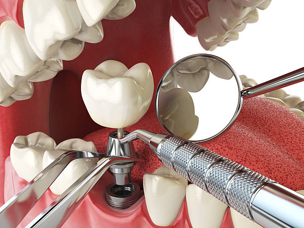 Best Emergency Wisdom Tooth Extraction in Parshall, ND